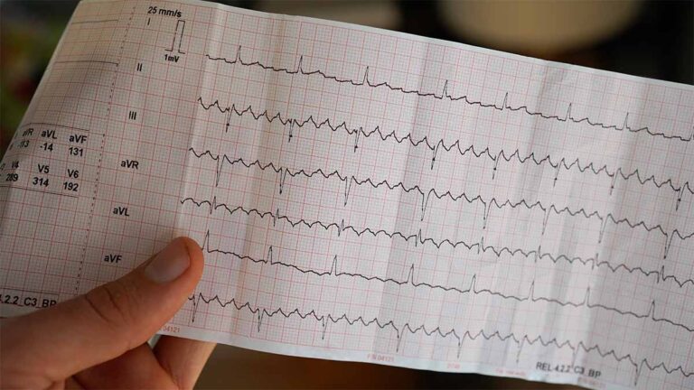 Un algorithme basé sur l'IA utilisé pour identifier le risque de fibrillation auriculaire beaucoup plus tôt