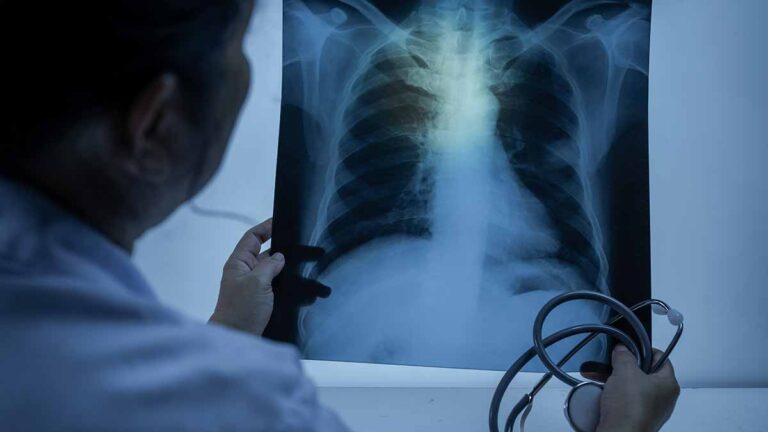 Les cas de tuberculose en Angleterre continuent d'augmenter – UKHSA