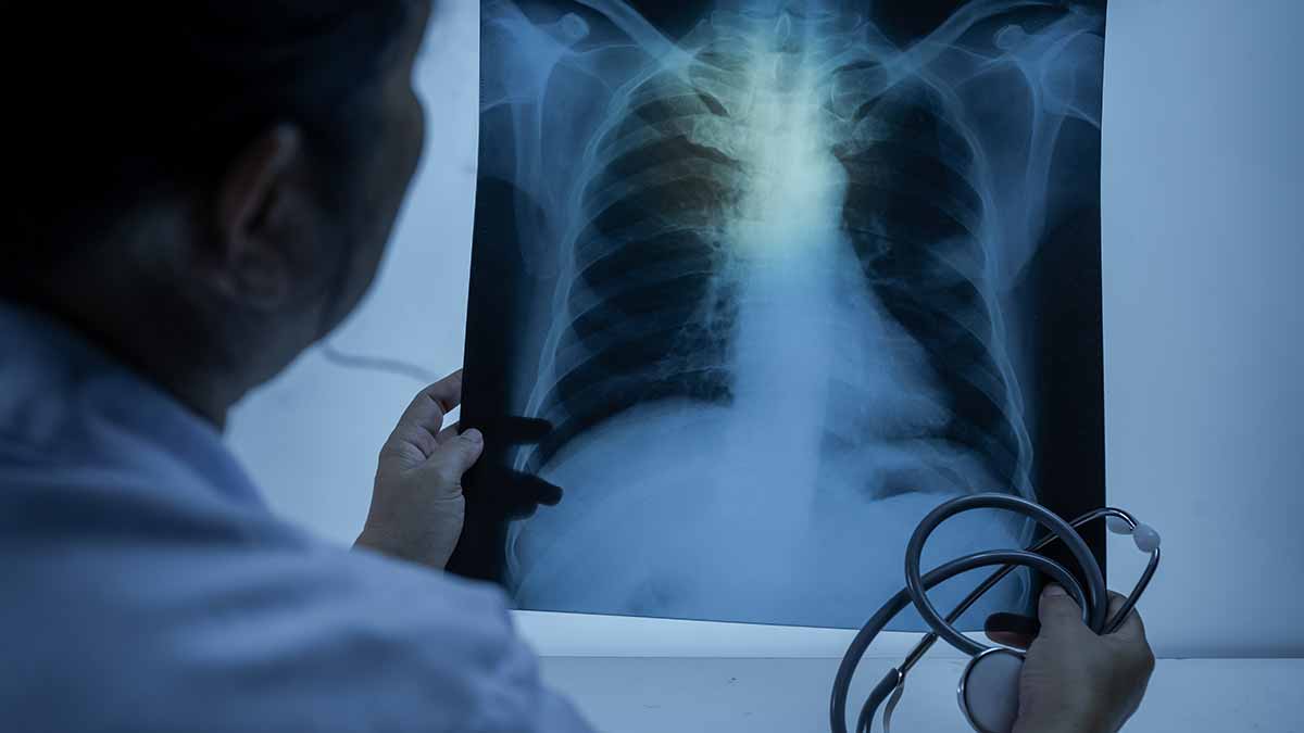 Les cas de tuberculose en Angleterre continuent d'augmenter - UKHSA